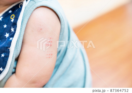 はんこ注射を打った赤ちゃんの腕の写真。子供の予防接種のイメージ。 はんこ注射を打った赤ちゃんの腕の写真。子供の予防接種のイメージ。 87364752