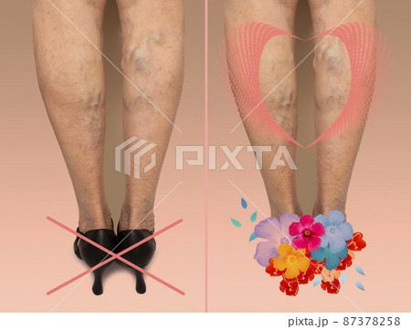 Painful varicose and spider veins on female legs. Senior woman in heels and tired legs. Comfort shoes concept 87378258