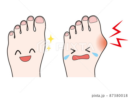 外反母趾の足と健康な足 87380018