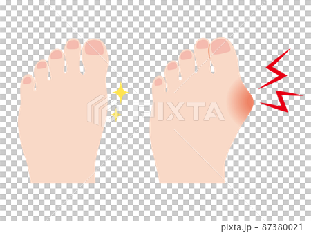 外反母趾の足と健康な足 87380021