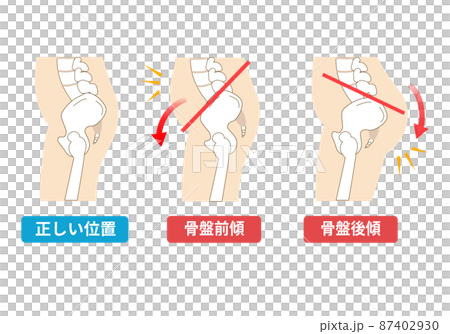 骨盆前傾和後傾 87402930