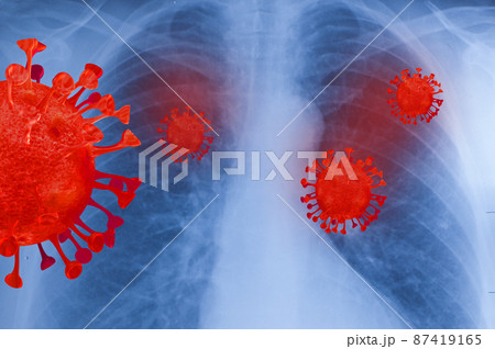 Chest X-RAY with lung injury from corona virus. Concept xray film lungs. Chest X-RAY with lung injury from corona virus. Concept xray film lungs. 87419165