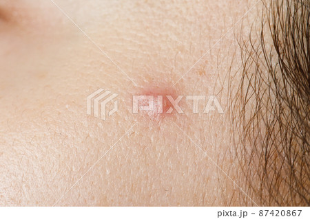 macro photo of a pimple 87420867