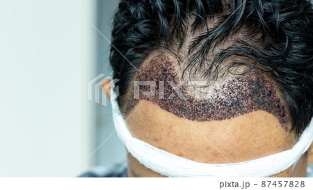 Man head with hair transplant surgery with receding hair line, FUE, Follicular unit extraction, Types of hair transplant procedures and their stages. Male alopecia treatment. 87457828