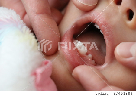 乳歯 (赤ちゃん ベビー 前歯 乳児 子供 女の子 赤ん坊 室内 屋内 口 マクロ アップ 唇) 87461383