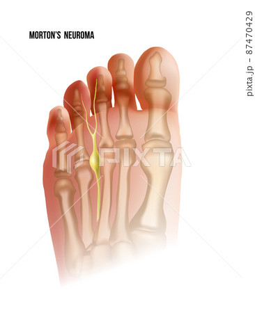 Mortons neuroma. Foot pain strain bottom view. Realistic anatomy illustration 87470429