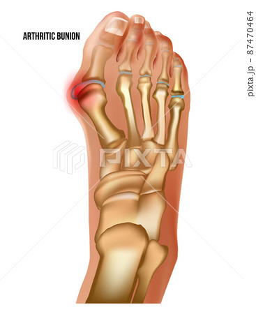 Artritic bunion rheumatoid sore joints, top view. Artritic bunion rheumatoid sore joints, top view. 87470464