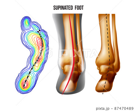 Supinated foot, arch deformation, bottom and back view . Foot weight distribution. Supinated foot, arch deformation, bottom and back view . Foot weight distribution. 87470489