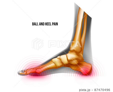 Ball and heel of foot pain bones skeleton realistic anatomy illustration 87470496