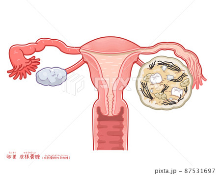 卵巣嚢腫・皮様嚢腫・奇形腫のイラスト 87531697