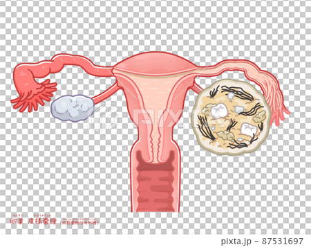 卵巣嚢腫・皮様嚢腫・奇形腫のイラスト 87531697