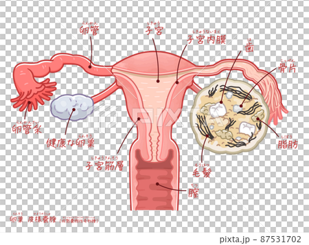 卵巣嚢腫・皮様嚢腫・奇形腫、イラスト、子宮 87531702