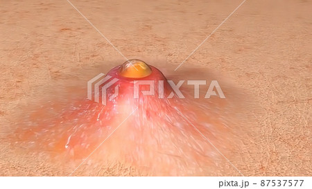 Acne And Pimples, Stages Of Development, Acne And Pimples, Stages Of Development, 87537577