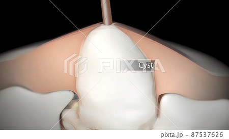 inflammatory acne occurs when bacteria infect clogged or closed pores 87537626