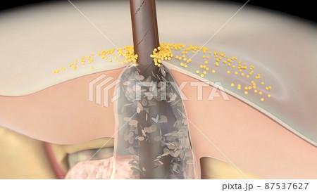 inflammatory acne occurs when bacteria infect clogged or closed pores 87537627