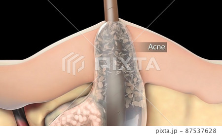 inflammatory acne occurs when bacteria infect clogged or closed pores 87537628