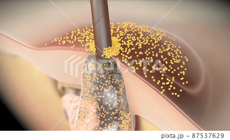 inflammatory acne occurs when bacteria infect clogged or closed pores 87537629