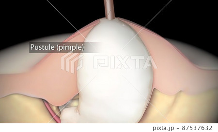 inflammatory acne occurs when bacteria infect clogged or closed pores 87537632