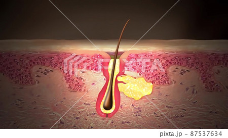 Acne And Pimples, Stages Of Development, 87537634