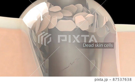 inflammatory acne occurs when bacteria infect clogged or closed pores 87537638