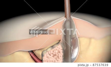 Acne or pimple formation.The sebum in the clogged pore encourages the growth of a certain bacteria Acne or pimple formation.The sebum in the clogged pore encourages the growth of a certain bacteria 87537639