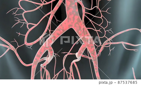 Formation of abdominal aortic aneurysm Formation of abdominal aortic aneurysm 87537685