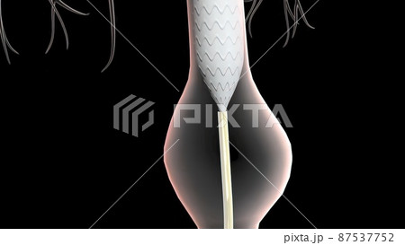abdominal aortic aneurysm treatment 87537752