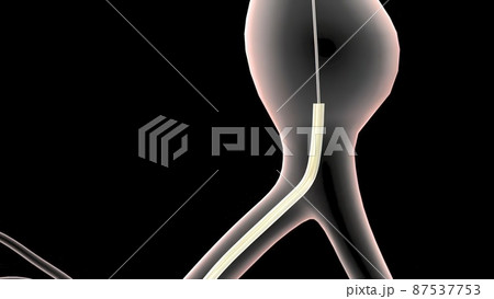 abdominal aortic aneurysm treatment abdominal aortic aneurysm treatment 87537753