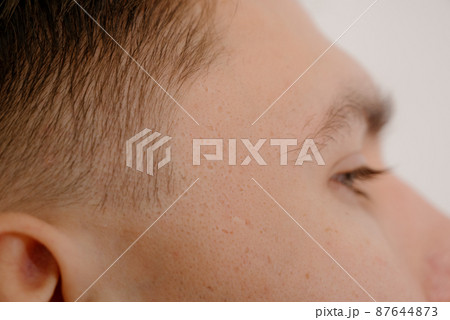 Close-up of problem skin with deep acne scars on a young man's cheek 87644873