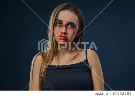 Suffering blonde girl in black t-shirt. Bleeding face covered with bruises, looking at the camera, sitting against blue background. Close-up Suffering blonde girl in black t-shirt. Bleeding face covered with bruises, looking at the camera, sitting against blue background. Close-up 87652202