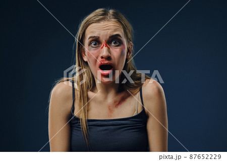 Panicked blonde lady in black t-shirt. Bleeding face covered with bruises, looking scared, sitting against blue background. Close-up 87652229