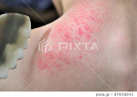 カッサか虐待で背中に残った皮下出血跡 87658042