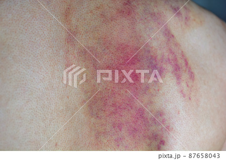 カッサか虐待で背中に残った皮下出血跡 87658043