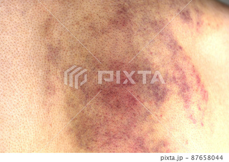 カッサか虐待で背中に残った皮下出血跡 87658044