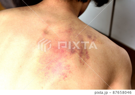 カッサか虐待で背中に残った皮下出血跡 カッサか虐待で背中に残った皮下出血跡 87658046