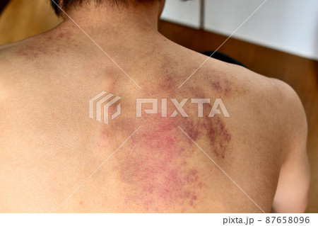 カッサか虐待で皮下出血跡が残った男性の背中 87658096