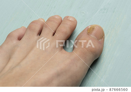 Toenails with fungus problems on green table close up Toenails with fungus problems on green table close up 87666560