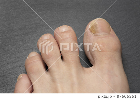 Toenails with fungus problems on gray table close up Toenails with fungus problems on gray table close up 87666561