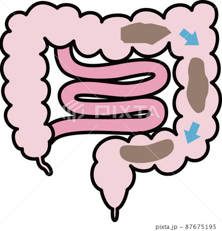 便秘のイラスト 便秘のイラスト 87675195