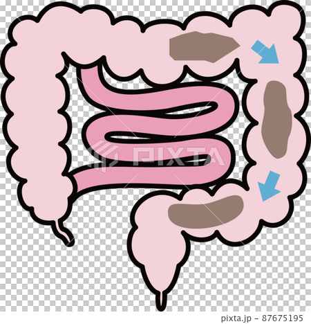 便秘のイラスト 便秘のイラスト 87675195