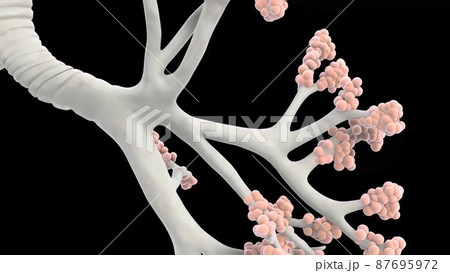 3D Medical illustration Respiratory System, Alveoli 87695972