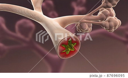3D Medical illustration Respiratory System, Alveoli 87696095