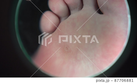 A magnifying glass zooms in on a wart on a girl's leg in a podiatrist's salon. View of the leg through a large magnifying glass. 87706881