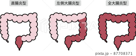 潰瘍性大腸炎のイラスト 潰瘍性大腸炎のイラスト 87708371