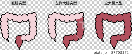 潰瘍性大腸炎のイラスト 潰瘍性大腸炎のイラスト 87708371