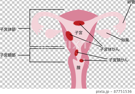 子宮 / 癌症插圖 子宮 / 癌症插圖 87751536