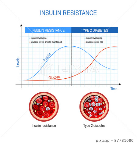 Insulin resistance and Type 2 diabetes. comparison and difference. high blood sugar. Chart with insulin and glucose levels. Cross section of blood vessel. Vector diagram 87781080