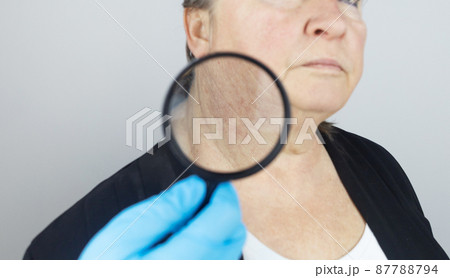 Rosacea on the skin of an old woman. Close-up of a capillary network. Redness on the skin. Problems with the outflow of blood in the capillaries. Doctor examines the problems of the patient Rosacea on the skin of an old woman. Close-up of a capillary network. Redness on the skin. Problems with the outflow of blood in the capillaries. Doctor examines the problems of the patient 87788794