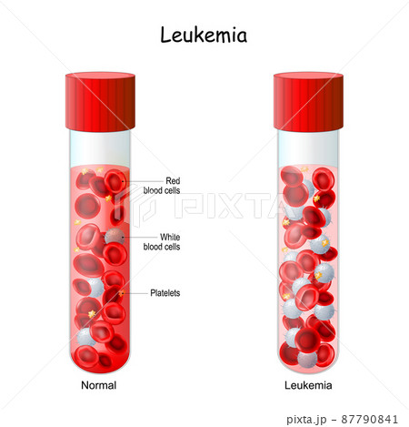 Leukemia. test tube with Normal blood and blood cancer. 87790841