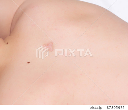Scar on a man's back after removal of an inflamed boil, scar, close-up, copy space, healthcare 87805975